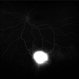 Von Hippel-Lindau Syndrome on FA Von Hippel-Lindau Syndrome on FA
