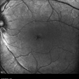 Retinal Dystrophy of 24-Year-Old Male/ Red Free OS Retinal Dystrophy of 24-Year-Old Male/ Red Free OS