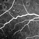 Fluorescein Angiogram - Tortuous Vessels of DME Right Eye