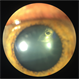 Lens Bite