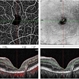Macular Telangiectasis Macular Telangiectasis