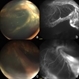 Pediatric Tractional Retinal Detachment Pediatric Tractional Retinal Detachment