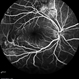 Multifocal Exudative Detachments Due to VKH Multifocal Exudative Detachments Due to VKH
