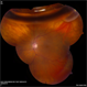 Sub Retinal Gas 1 Day Post Pneumatic Retinopexy
