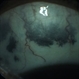 Nevus of Otta Nevus of Otta
