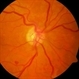 PDR Neovacularization of the Disc