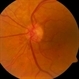 PDR Neovacularization of the Disc PDR Neovacularization of the Disc