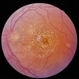 Optic Neuritis Optic Neuritis