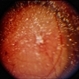 Choroidal Melanoma With Vitreous Seeding Choroidal Melanoma With Vitreous Seeding