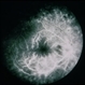 Necrotizing Retinitis Necrotizing Retinitis