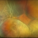 Choroidal Detachment OS Choroidal Detachment OS