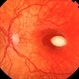 Congenital Macular Changes Congenital Macular Changes