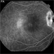 Optic Nerve Pit Related Serous Retinal Detachment