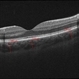 06- Unilateral Acute Idiopathic Maculopathy (UAIM) - OCT OS 06- Unilateral Acute Idiopathic Maculopathy (UAIM) - OCT OS