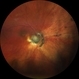 Morning Glory Disk Anomaly Morning Glory Disk Anomaly
