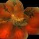 Pigmentary Paravenous Retinochoroidal Atrophy (Left Eye) Pigmentary Paravenous Retinochoroidal Atrophy (Left Eye)