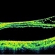 Bilateral Myopic Foveoschisis