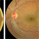 Subretinal Cysticercosis Post Vitrectomy Subretinal Cysticercosis Post Vitrectomy