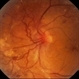 NVD in Proliferative Diabetic Retinopathy NVD in Proliferative Diabetic Retinopathy