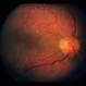Fabry's Disease Fabry's Disease