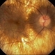 Choroideremia Choroideremia