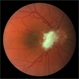 Pre-Retinal Fibrosis Following Endogenous Fungal Endophthalmitis Pre-Retinal Fibrosis Following Endogenous Fungal Endophthalmitis