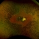 Sympathetic Ophthalmia Sympathetic Ophthalmia