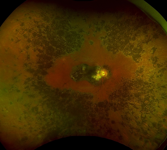 Sympathetic Ophthalmia Retina Image Bank