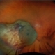 Choroidal Melanoma Choroidal Melanoma