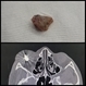 Intraocular Foreign Body