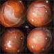Giant Retinal Tear