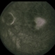 Juxtafoveal Telangiectasis / DM / Diabetes
