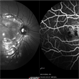 Choroidal hemangioma Choroidal hemangioma