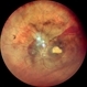 Subretinal Hemorrhage Subretinal Hemorrhage