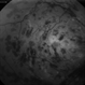 Lupus Retinopathy