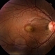 Idiopathic Choroidal Neovascularization Idiopathic Choroidal Neovascularization