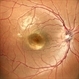 Best Vitelliform Macular Dystrophy