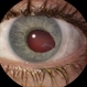 Corneal Perf Fibrotic Strand