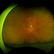 Hydroxychloroquine Maculopathy Hydroxychloroquine Maculopathy