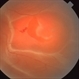 Retinal Tear with Retinal Detachment Retinal Tear with Retinal Detachment
