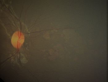 bear tracks retina garners syndrome