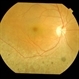 Sectoral Retinitis Pigmentosa