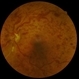 Central retinal vein obstruction (CRVO) Central retinal vein obstruction (CRVO)