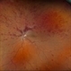 Central Retinal Vein Occlusion With Macular Edema Central Retinal Vein Occlusion With Macular Edema