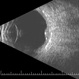 Discrete Choroidal Hemangioma B-Scan Discrete Choroidal Hemangioma B-Scan