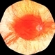 Albinotic Fundus Albinotic Fundus