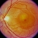 Central Serous Chorioretinopathy (CSR)