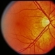 Optic Nerve Meningioma Optic Nerve Meningioma