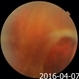Longstanding Retinal Detachment Secondary to a Larg Retinal Tear Longstanding Retinal Detachment Secondary to a Larg Retinal Tear