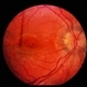 Pseudotumor Cerebri Pseudotumor Cerebri